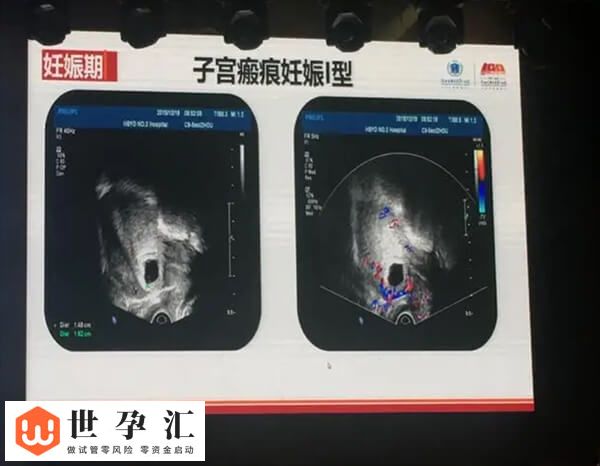 试管可不可以避开子宫疤痕(图2) 试管可不可以避开子宫疤痕(图2)
